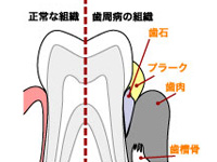 歯周病の恐ろしさ